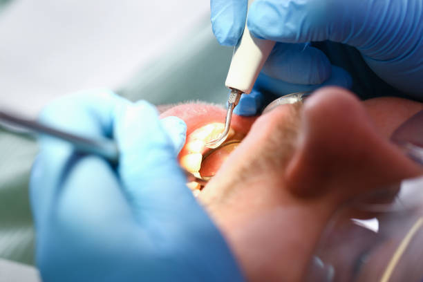 Best Emergency Wisdom Tooth Extraction in Landover, MD