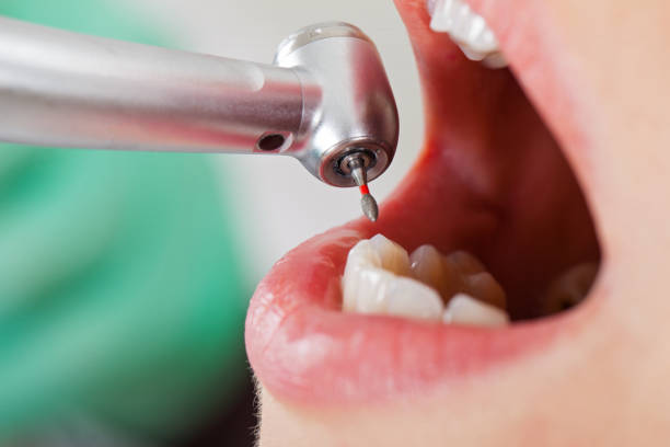 Best Lost Filling or Crown Replacement in Landover, MD